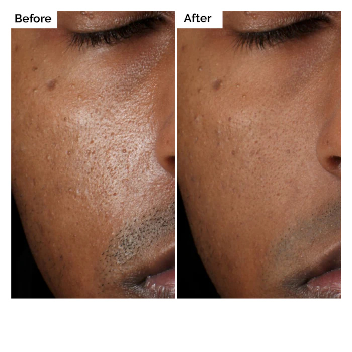 Aloe 2% + NAG 2% Solüsyon Seru - Aha Bha Exfoliant incelemesi ve fiyatı